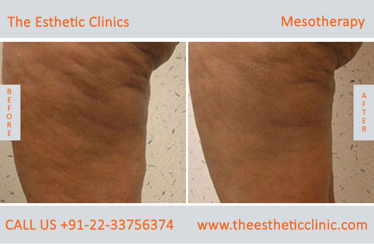 Mesotherapy for Hair Loss Face Skin Treatment before after photos in mumbai india (2)